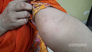 হঠাৎ খোসপাঁচড়া বাড়ছে কেন?