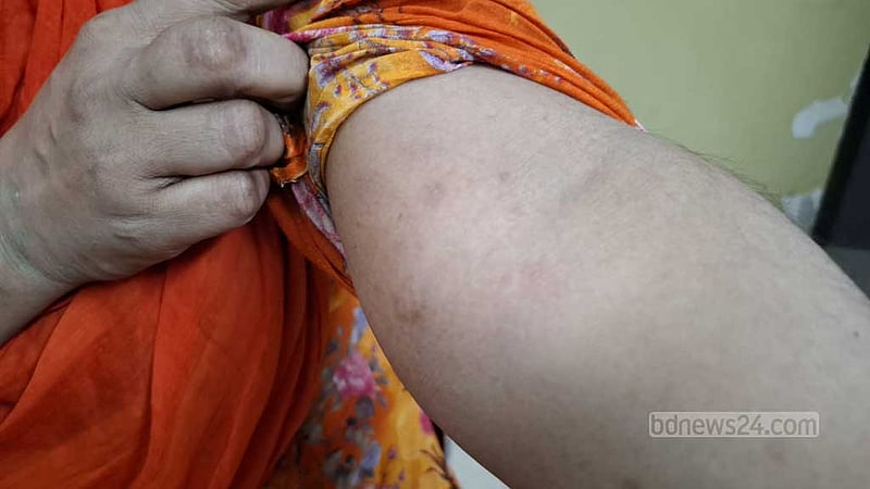 হঠাৎ খোসপাঁচড়া বাড়ছে কেন?