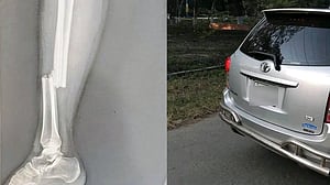 রাজশাহী বিশ্ববিদ্যালয়ে শিক্ষকের গাড়ির ধাক্কায় পা ভাঙল ছাত্রীর