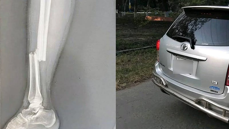 রাজশাহী বিশ্ববিদ্যালয়ে শিক্ষকের গাড়ির ধাক্কায় পা ভাঙল ছাত্রীর