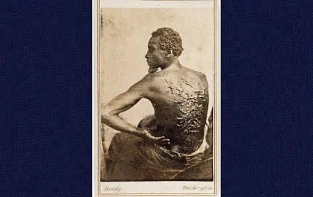 A photo taken in 1863 of a slave known only as “Peter”, showing severe scarring from whippings. This historical artifact may no longer be displayed to the public by US institutions. 