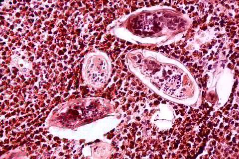 1973
Dr. Edwin P. Ewing, Jr.

Histopathology of schistosomiasis haematobia, bladder

Histopathology of bladder shows eggs of Schistosoma haematobium surrounded by intense infiltrates of eosinophils.  Parasite.