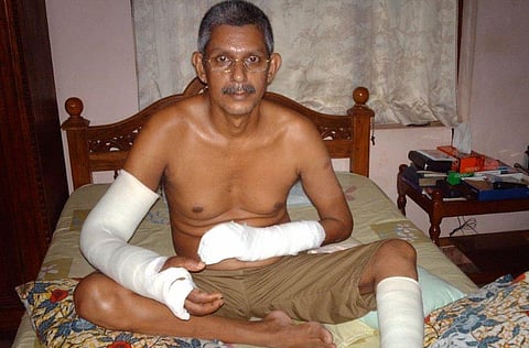 Professor T J Joseph, whose right palm was chopped off in a 2010 attack allegedly linked to a controversial examination question paper.