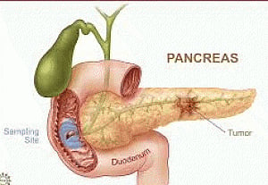 Artificial pancreas may transform diabetes treatment