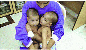 A feather in AIIMS's cap: Separated conjoined twins healthy