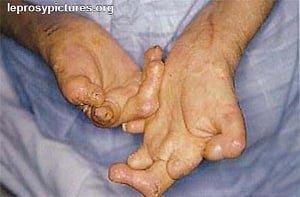 Multi-drug therapy's role in leprosy control hailed