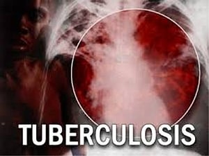 Sputum test may not hold key to TB eradication