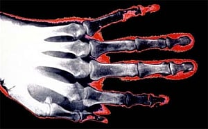 High BP pill could ease arthritis pain