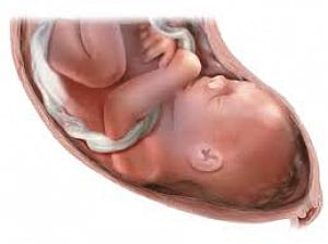 44-year-old 'stone baby' removed from 84-year-old woman