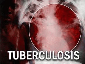 Control TB in India for world's sake: President