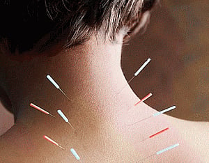 A Kuwaiti princess learns acupuncture in Mumbai