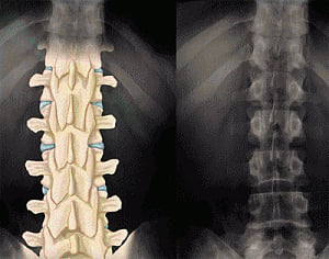 Spine function test for back pain treatment