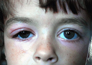 Toddler's eye contact may signal autism risk