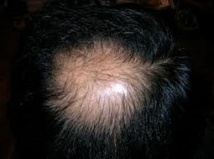 New drug restores hair growth in human trials