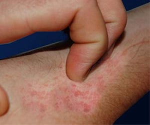 Why scratching makes an itch worse