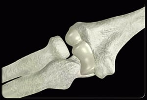 Drugs for bone loss may help prevent uterine cancer