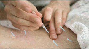 Acupuncture curbs hot flashes in breast cancer survivors