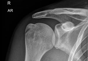 Gene responsible for fracture risk identified