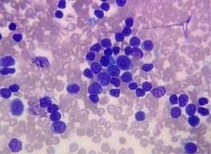 living near highway may increase leukemia risk in kids