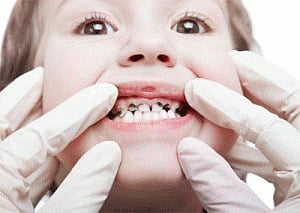Mother's stress linked to dental cavities in children