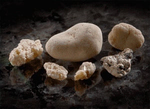 Kidney stones linked to heart disease risk in children