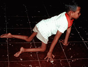 Fewer children with polio: UN
