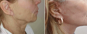 Canadian doctors make scar-free plastic surgery possible