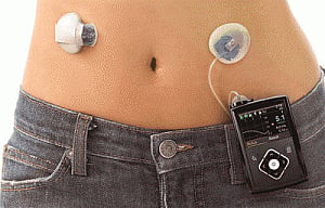 Artificial pancreas performed well in humans in US