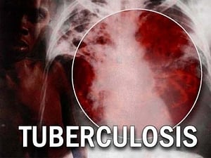 CDFD scientists discover protein linked to tuberculosis
