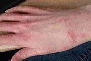 Asthma may increase risk of painful skin rash