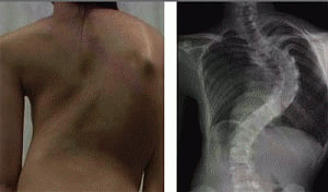 Gene responsible for familial scoliosis identified