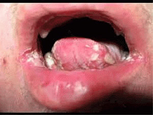 Gum-disease bacteria may also give cancer a boost