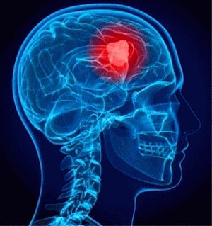 Tetanus shot may boost brain cancer survival