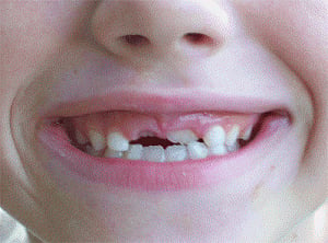 Baby teeth may hold clues to future health risks