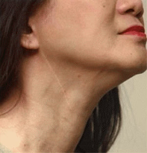 Swollen neck glands may indicate cancer