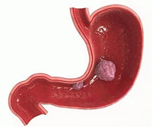 Gastrointestinal tumours can lead to additional cancers
