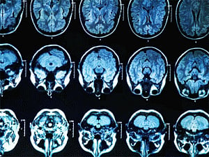 Brain scans to help people with Obsessive-Compulsive Disorder