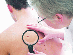 Beware of the mole that never heals