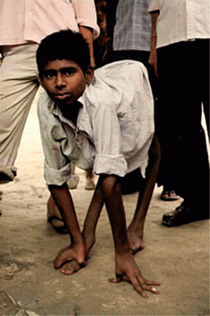 Southeast Asian countries urged to prevent polio resurfacing