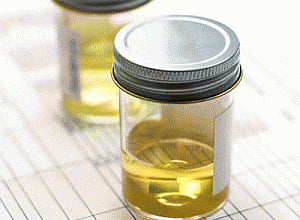 Urine odour can indicate Alzheimer's disease