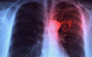 'Advanced diagnostics important to detect genital TB'