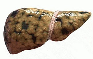 Fatty liver poses risk of heart dysfunction in obese