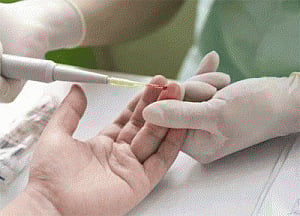 Blood test may indicate skin cancer relapse