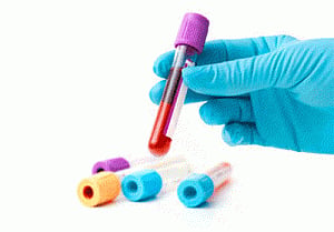 New blood test diagnoses Alzheimer's at initial stage