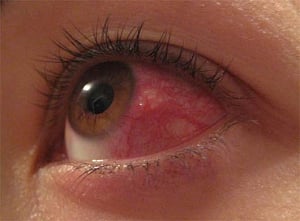 Contact lenses may alter eye's natural bacteria, says study