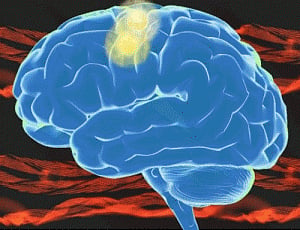 Reduced dosage of clot-busting drug can improve stroke treatment