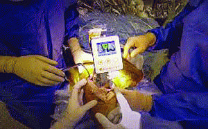 OrthAlign improves alignment positioning of knee implants