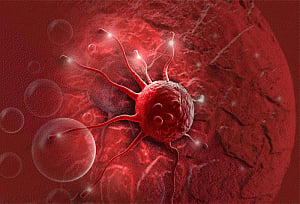 High-tech scans could spare cancer patients from intensive chemotherapy