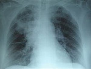 New method helps faster detection of pathogens in lungs