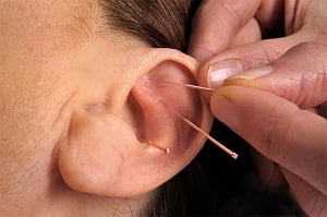Auricular acupuncture effective for headache-related Qol